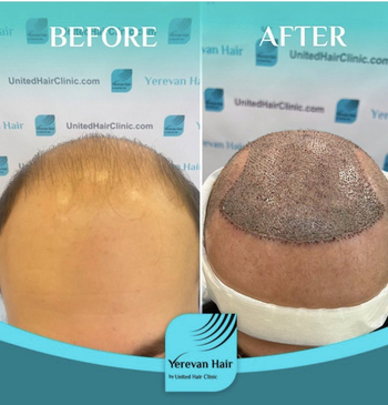 Slider image (2) United Hair Clinic